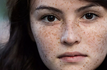 祛斑要趁早，外斑一颗，内斑一窝